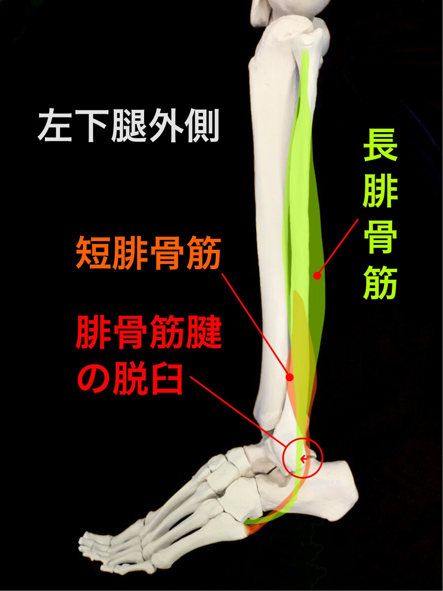 腓骨筋腱脱臼 足関節外側の痛み 外くるぶし後ろのだるさや痛み 藤田鍼灸整骨院藤田鍼灸整骨院