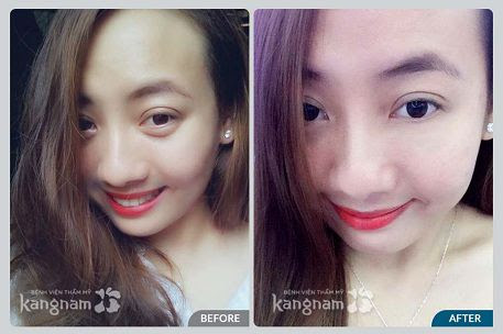 Kết quả chữa bọng mỡ mắt tại Kangnam