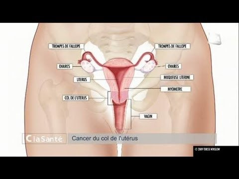 chimiothérapie most cancers des intestins