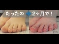 √100以上 足 浮き 指 改善 287541