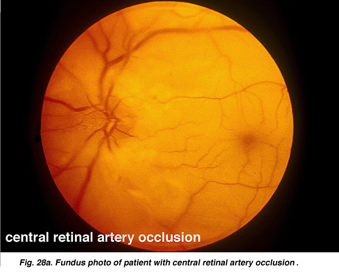 The Electroretinogram And Electro Oculogram Clinical