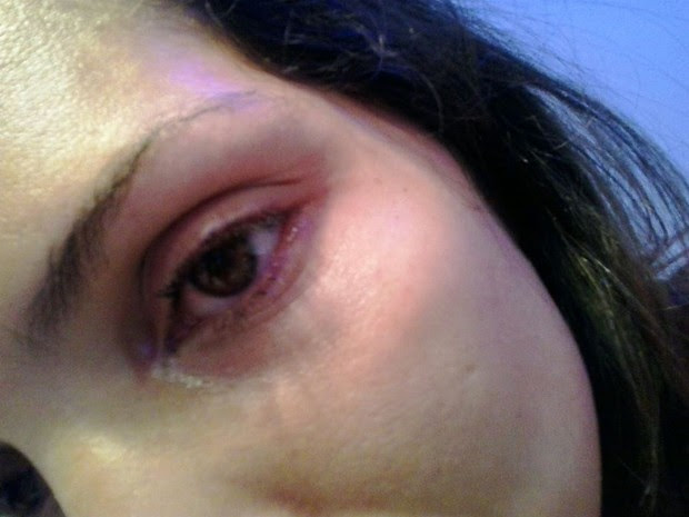 Lucilene fotografou olho inchado após briga (Foto: Arquivo Pessoal)