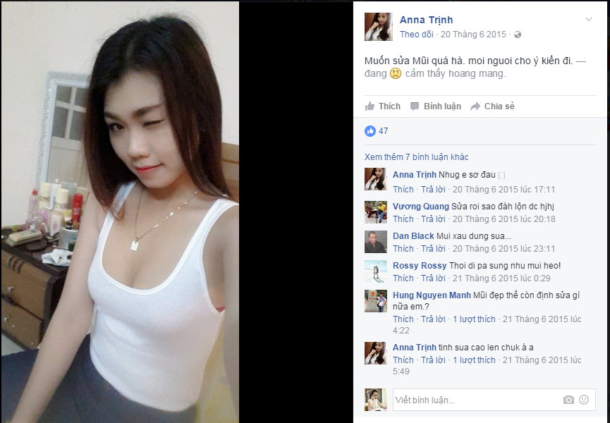 anna trịnh sửa mũi 2