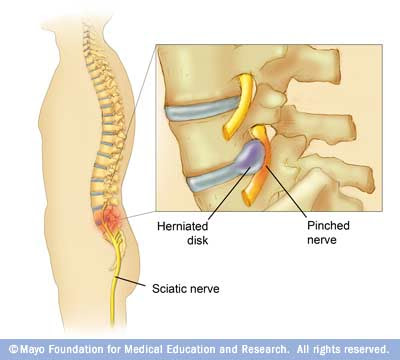 Pinched nerve in tailbone