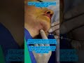  الحصول على الذقن المثالي مع شد الوجه بالخيوط PDO: نصائح من الطبيب