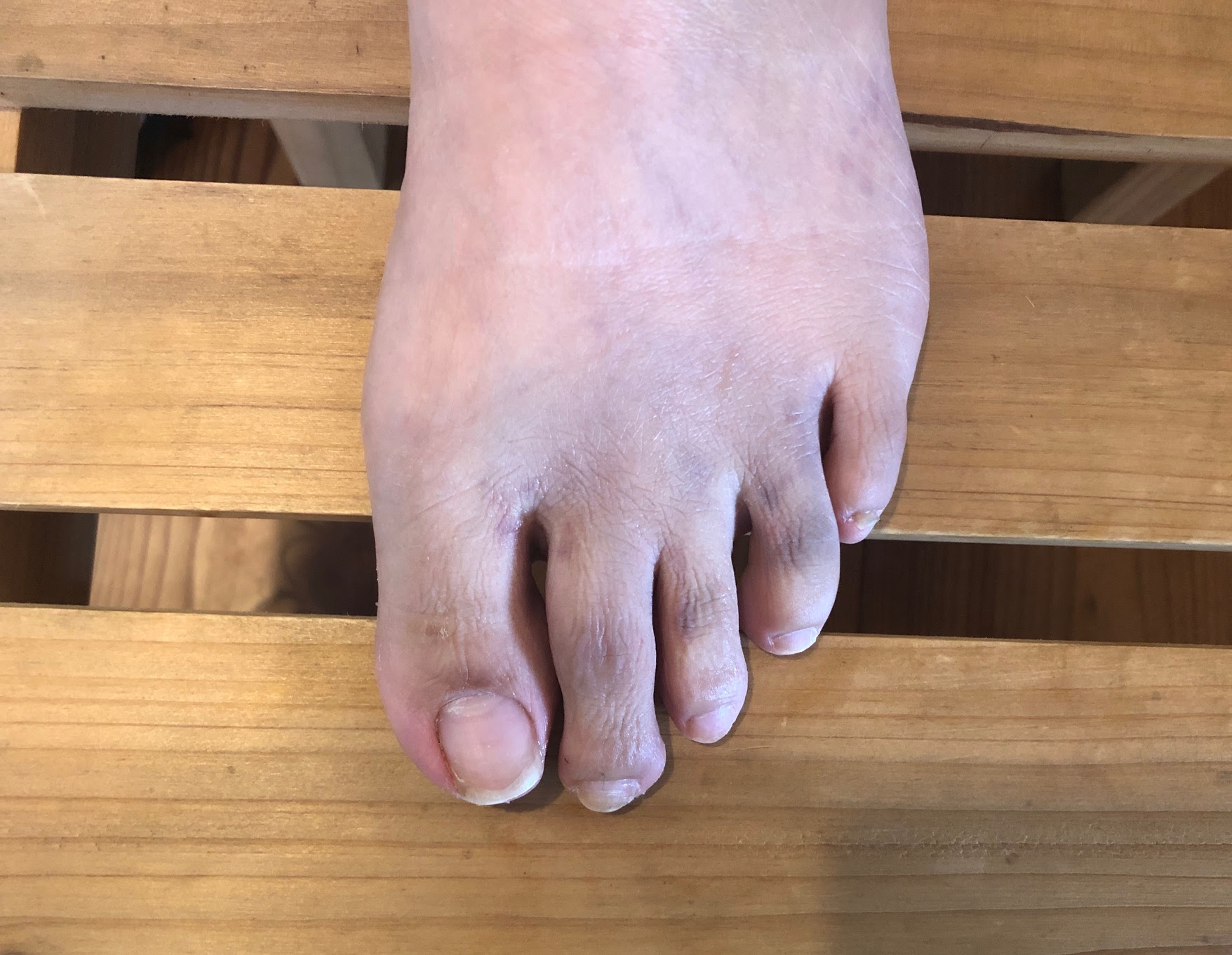 足の指をぶつけて痛い 内出血している 足の指の骨は折れやすい 放っておかずに早目に治療しましょう すみだ整骨院 直方 飯塚 田川 八幡で整骨院なら