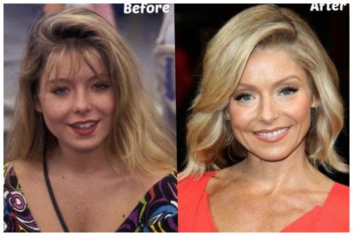 Megyn Kelly facelift before and after photos