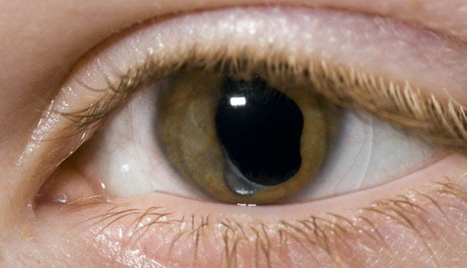  cataracts can develop after an eye injury, sometimes years later