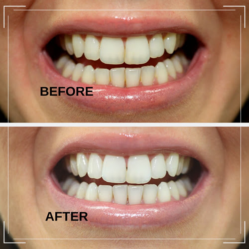 Food and drink after laser teeth whitening