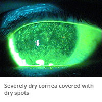 Dry Eyes University Eye Specialist