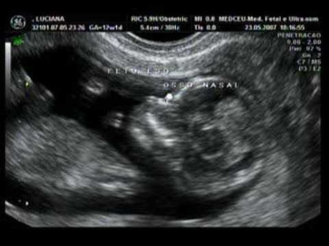 Ecografia de nena de 12 semanas - Imagui