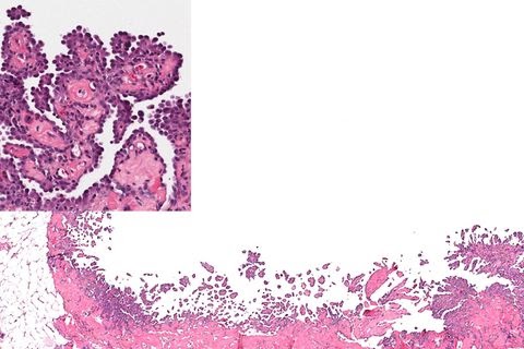Malignant Mesothelioma Types Of Cancer / Understanding your Cancer Diagnosis and Management | Greenslopes Oncology