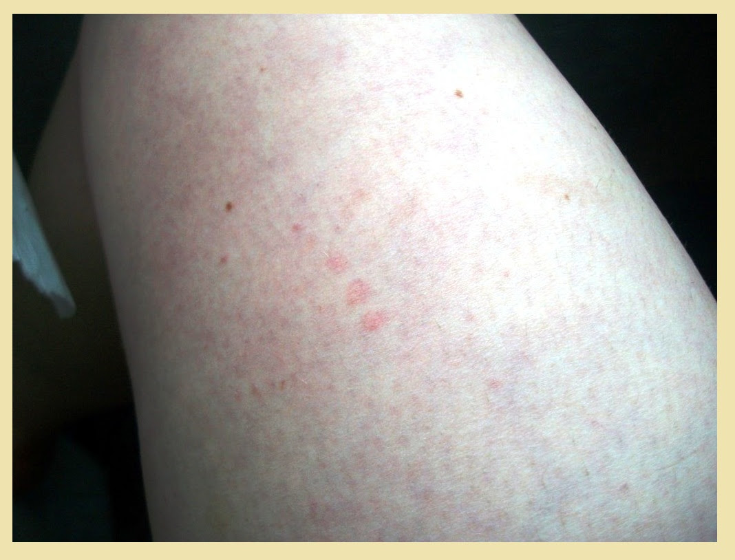 Bedbug Bites | The CO2 Bedbug Trap