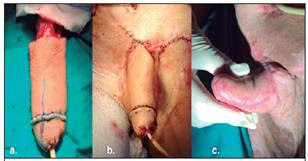 (Penile reconstruction with microsurgery)