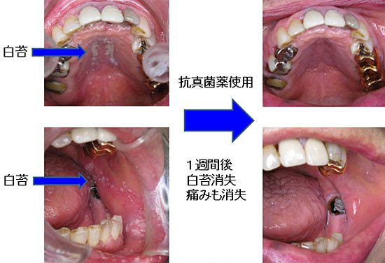 口腔カンジダ症 又吉歯科医院