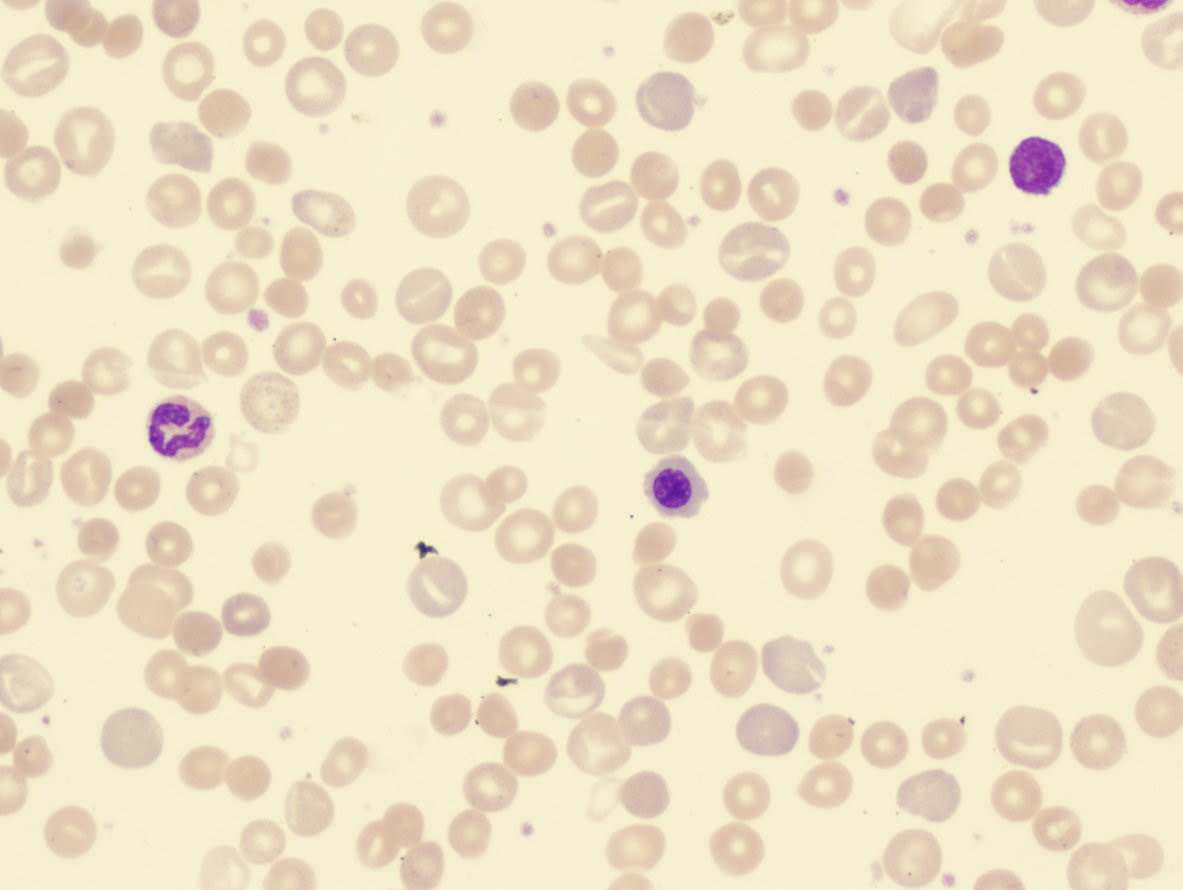 anemia - hemolitica -autoinmune.