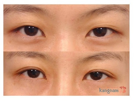 Sau bấm mí mắt Hàn Quốc cần kiêng khem những gì?556