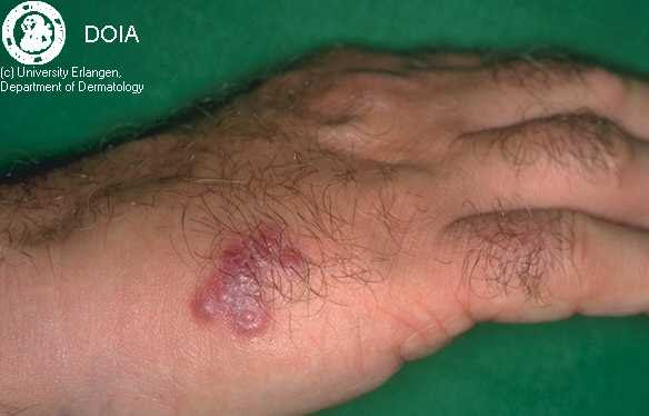 herpes pictures in mouth. HSV on Hand