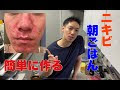 [最も人気のある！] アーモンドミルク ニキビ 598621-アーモンドミルク ニキ
ビできる