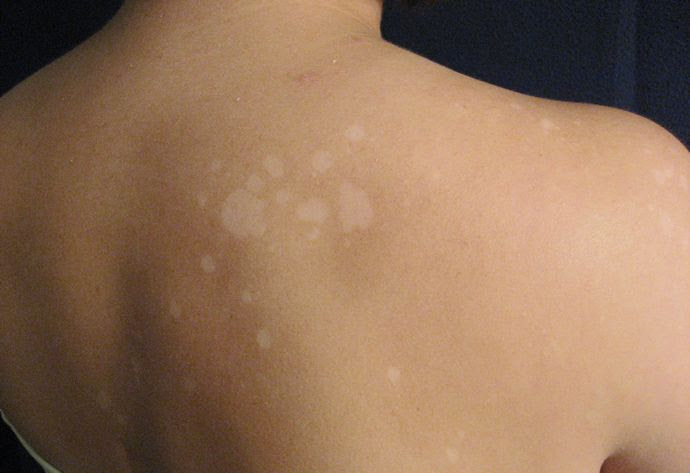 How can I remove white sun spots?