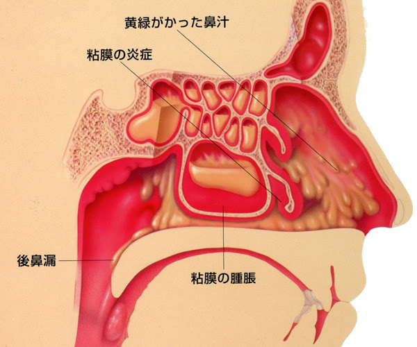 鼻水がのどにおりて困るかたへ 朴澤耳鼻咽喉科 News
