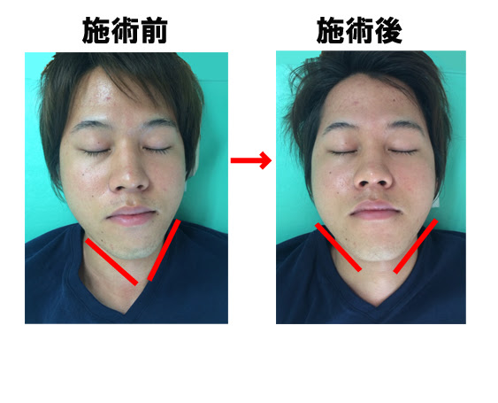 小顔矯正 整顔矯正 で今までのコンプレックスを解消 鼻の曲りは手術しなくても治る 杉並区で整骨院 接骨院をお探しの方は ほうなん町整骨院