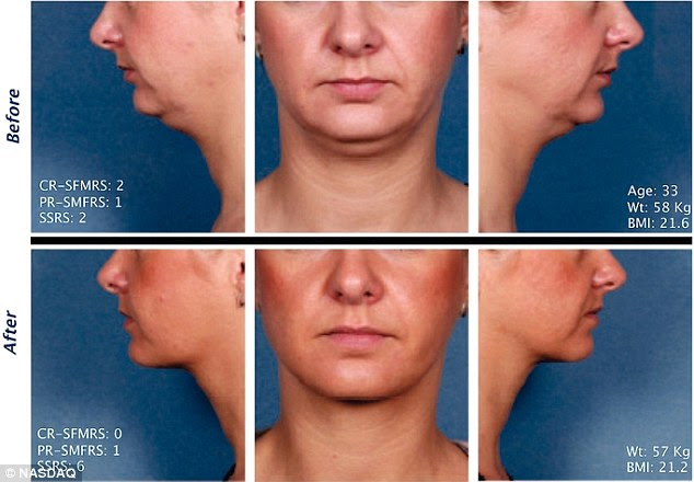 Resultado de imagem para Ways to Get Rid of That Double Chin Without Pills, Injections, or Surgery