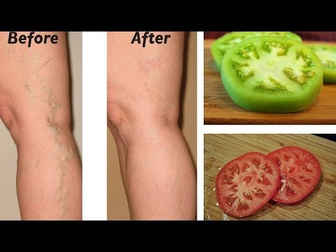 How to Heal Varicose Veins Using Tomato