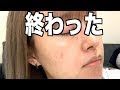 200以上 ハード ケミカル ピール 193039