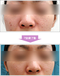 町田市の鶴川皮膚科クリニック ケミカルピーリング