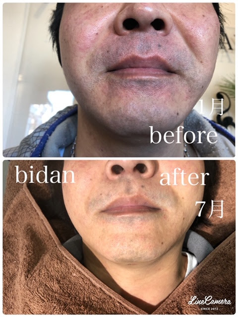 毎日の髭剃り 青ひげでカミソリ負けが気になる方は この際ひげ脱毛しちゃいましょう メンズ脱毛 フェイシャル 美男 群馬県太田市