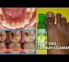 Cara Mengobati Sakit Gigi Yang Ampuh
