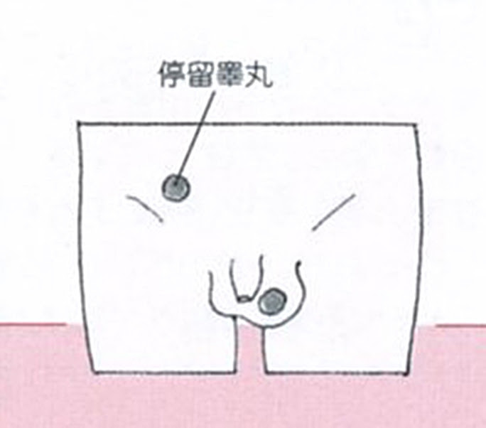 きのした小児科 陰嚢水腫 停留睾丸