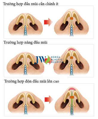 Phẫu thuật mũi cà chua như thế nào?