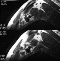 Non-Hodgkin lymphoma in a 58-year-old man. Sagitta