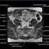 Pelvis Muscles Mri Anatomy - MRI pelvis anatomy | free male pelvis axial anatomy / In the back the posterior superior iliac spines are surrounded by muscles and flank fat.