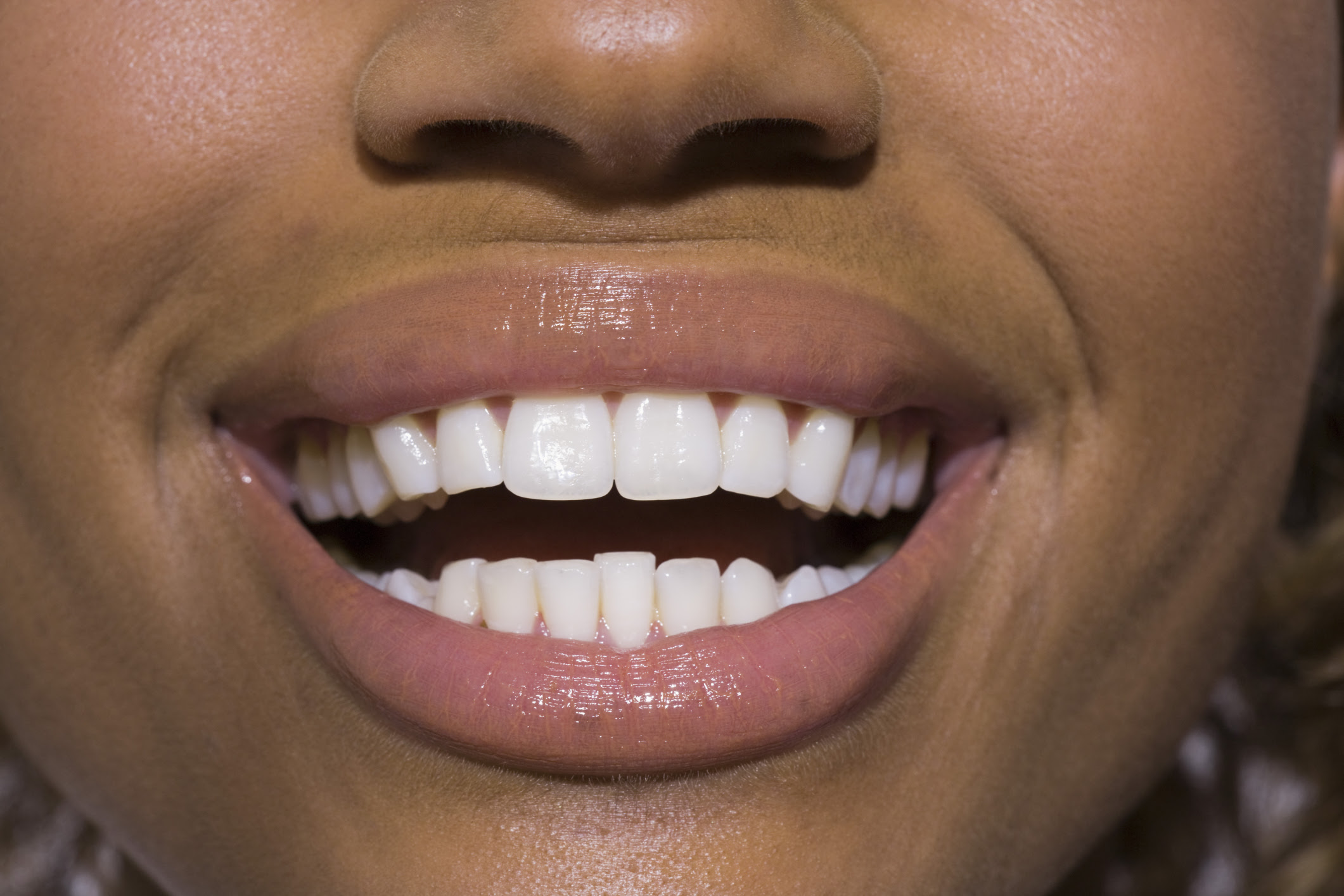 Can a dentist whiten my teeth