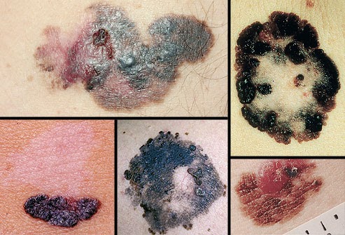Types Of Skin Cancer On Your Face : Histoplasmosis: Cause, Types & Complications | Types of skin rashes