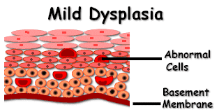 Mild cervical dysplasia
