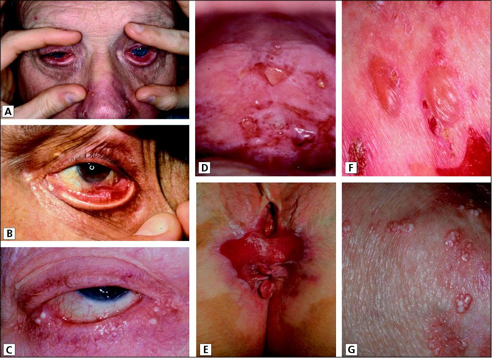 Ocular pemphigoid (cicatricial pemphigoid, benign mucous membrane pemphigoid) is a severe debilitating and blinding chronic cicatrizing disorder that .