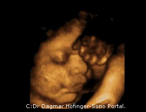 35 Sg Ou 37 Sa Moi Toi Et Notre Troisia Me Bonheur Accouchement Pra C Vu Le 16 Octobre 11