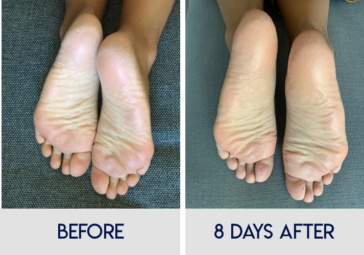 How Do Foot Peels Work An 8 Day Journal With Before After Pics Quiet Like Horses