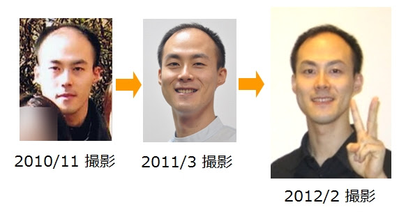 ぜっぺき頭が嫌でなおしたい方 髪型 ヘアアレンジが気になる方 ぜっぺき頭の矯正 オーストラリア州立大学カイロプラクティック医学の学位保持者がぜっぺき頭を集中施術