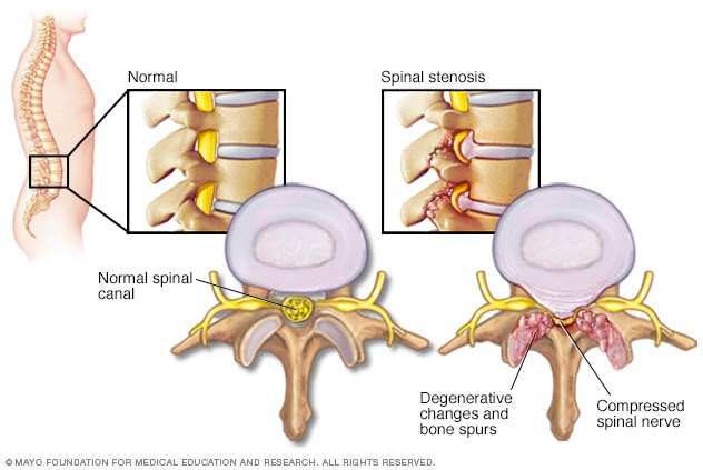STENOSIS SPINAL