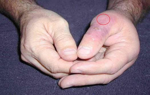 spider bite. spider bite brown recluse