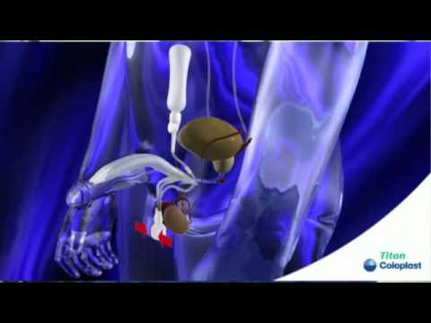 Erectile Dysfunction and Penile implants Treatment Prostate Cancer ...