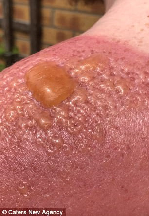  Vết bỏng khủng khiếp của Greg Binnie khi anh phơi trần làm việc dưới nắng nóng nhiều giờ liền. Ảnh: Caters New Agency. 