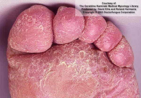 足癬tinea Pedis 快樂小藥師im Pharmacist Nichts Glucklich 痞客邦