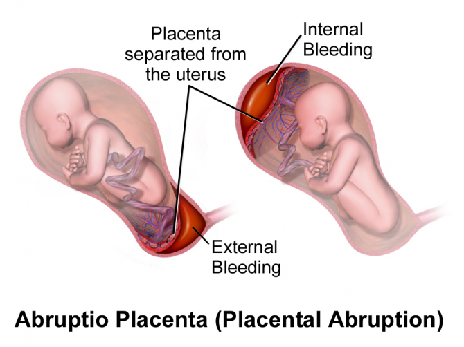 Blausen_0737_PlacentalAbruption