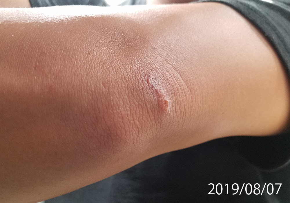 マジおっかねぇブヨ ヽ D ﾉ 釣り人が語る 磯ブヨに噛まれた後の経過観察と最善の対処法 ごまプリンの沖釣りに行こうよ